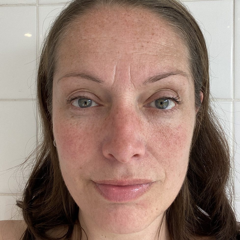 hyperpigmentation on skin hyperpigmentation on skin