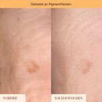 5 ML JUNGLÜCK JUNG PFLEGE GESICHT Pigmentflecken & Pickelmale Roll-On  6 of 7 Pigmentflecken & Pickelmale Roll-On