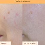 5 ML JUNGLÜCK JUNG PFLEGE GESICHT Pigmentflecken & Pickelmale Roll-On  4 of 7 Pigmentflecken & Pickelmale Roll-On